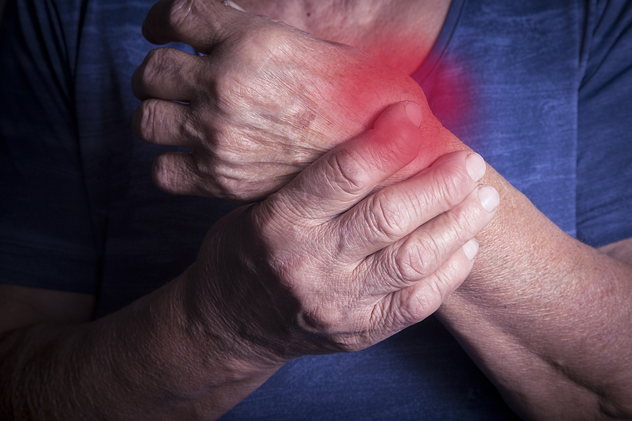 Hand Deformed From Rheumatoid Arthritis Woman Suffering from Lupus